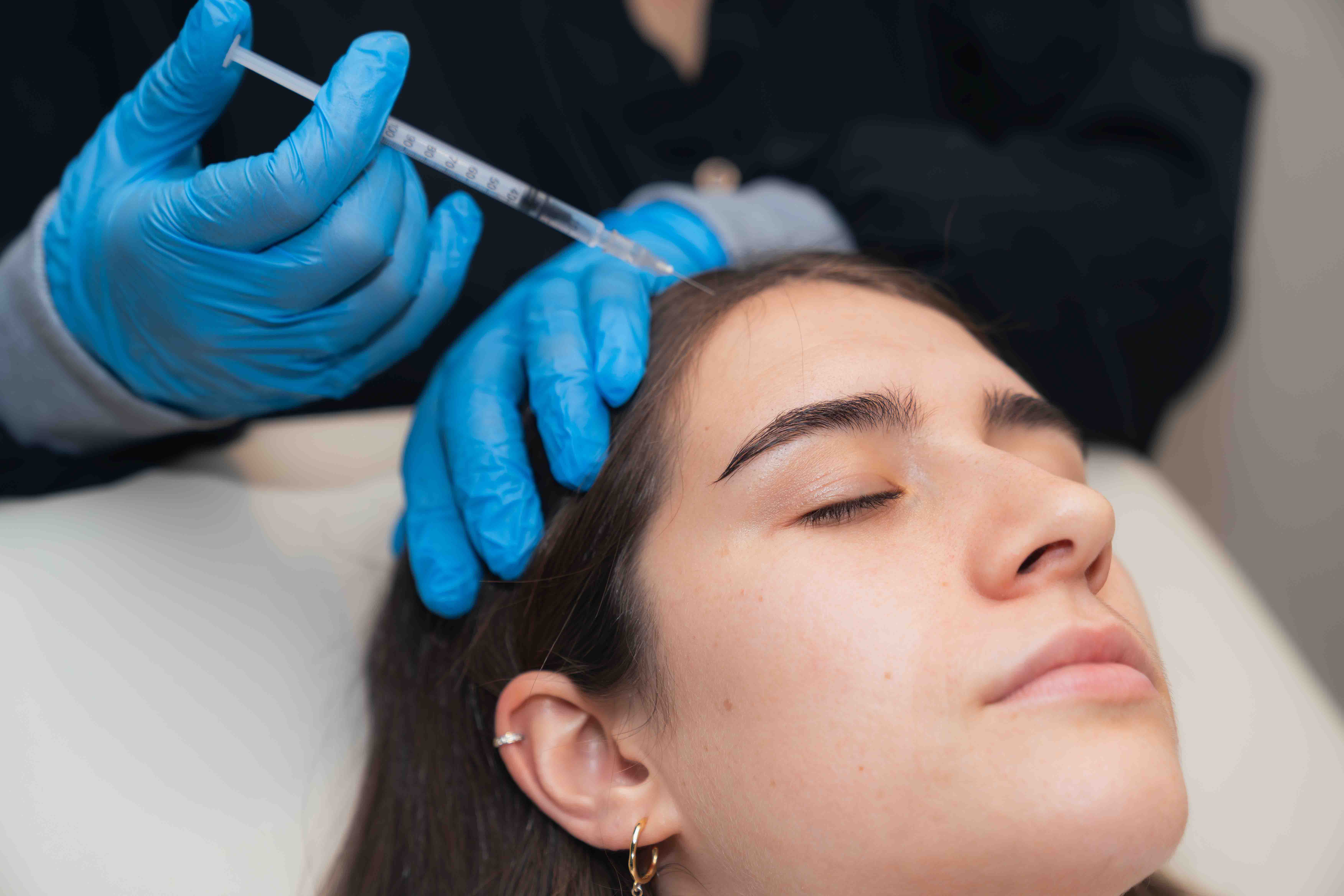 Mesoterapia capilar