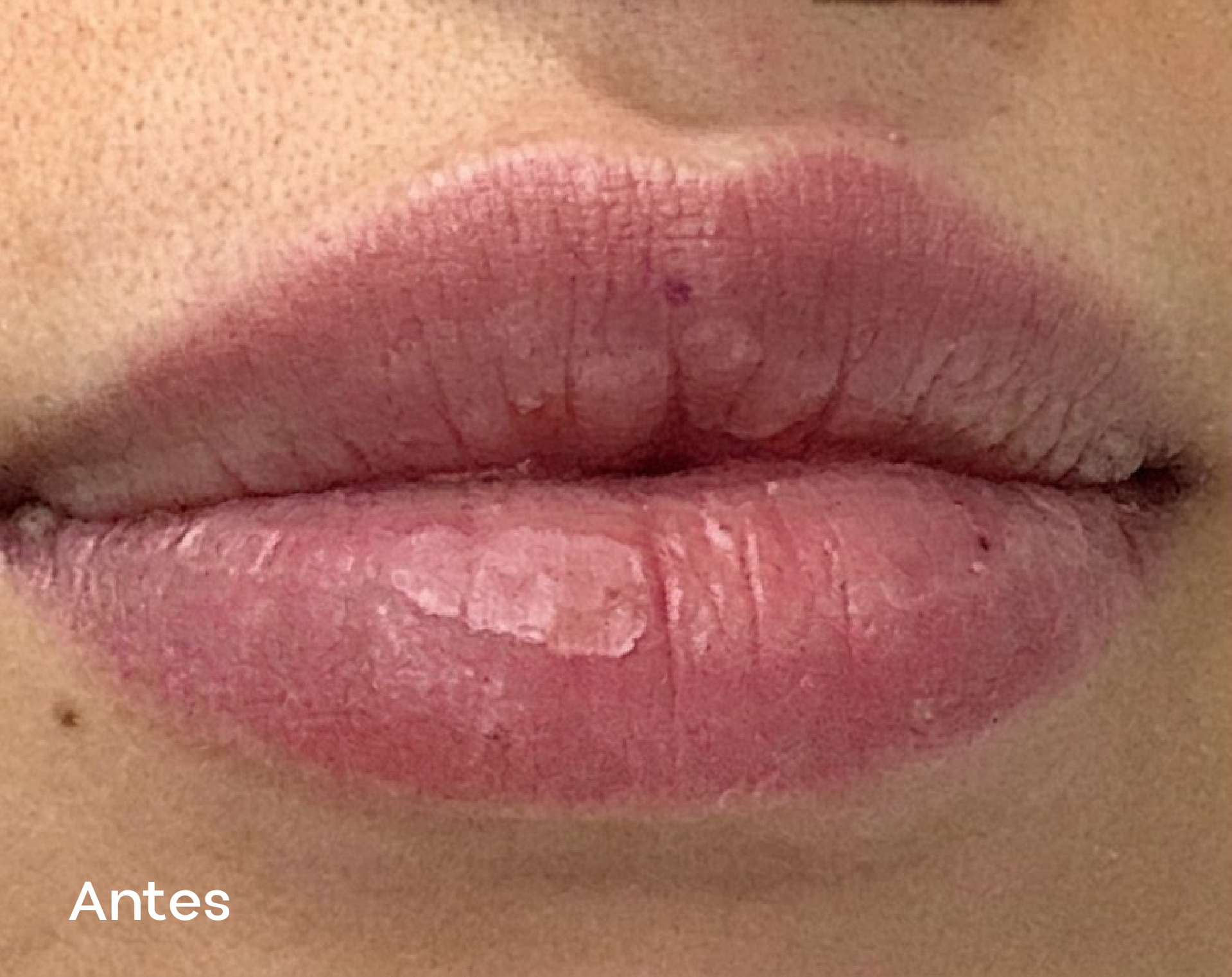 Resultados faciales labial