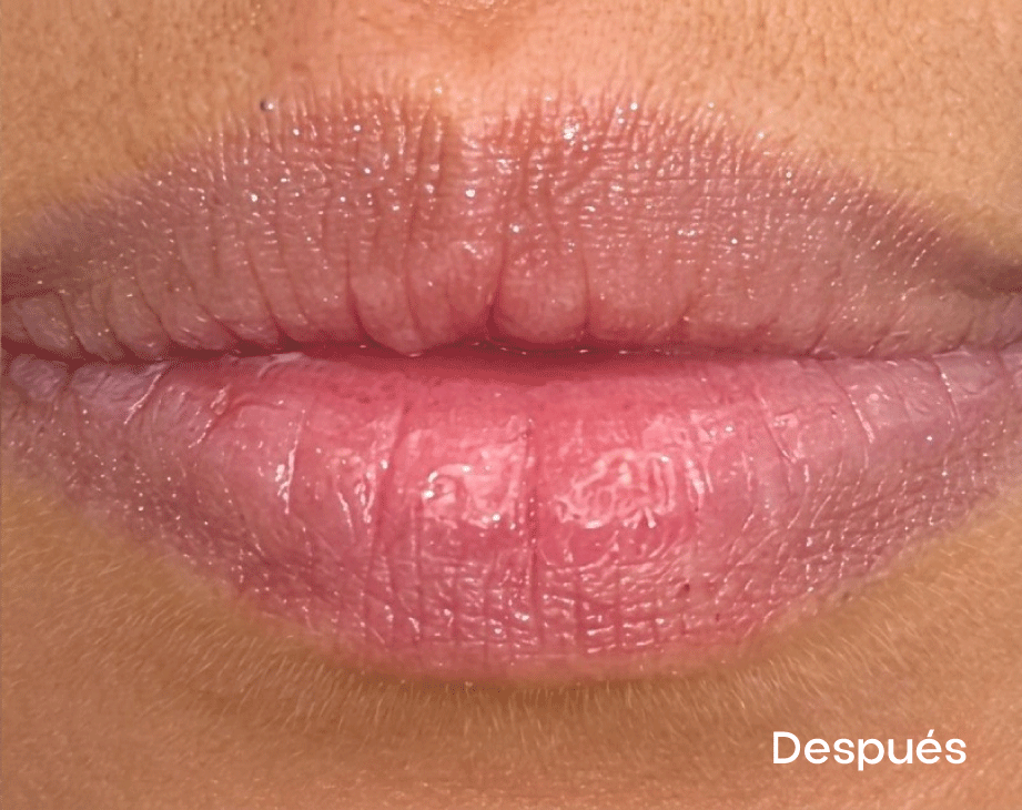Resultados faciales labial